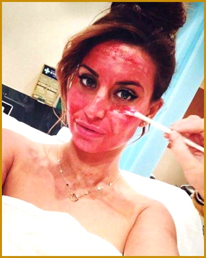 While TOWIE s Ferne McCann was the latest star to the cosmetic treatment 524419