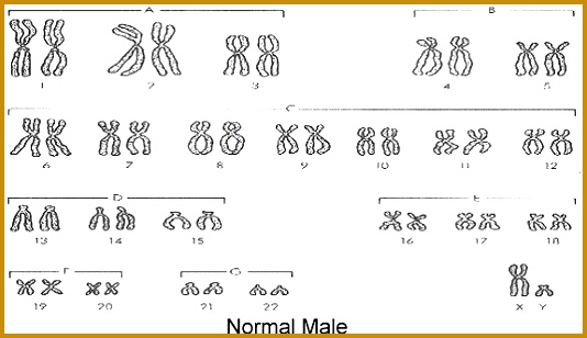 Notice that a person with Down Syndrome has an extra chromosome 21 Instead of a pair this person has 3 chromosomes a condition called TRISOMY tri 308534