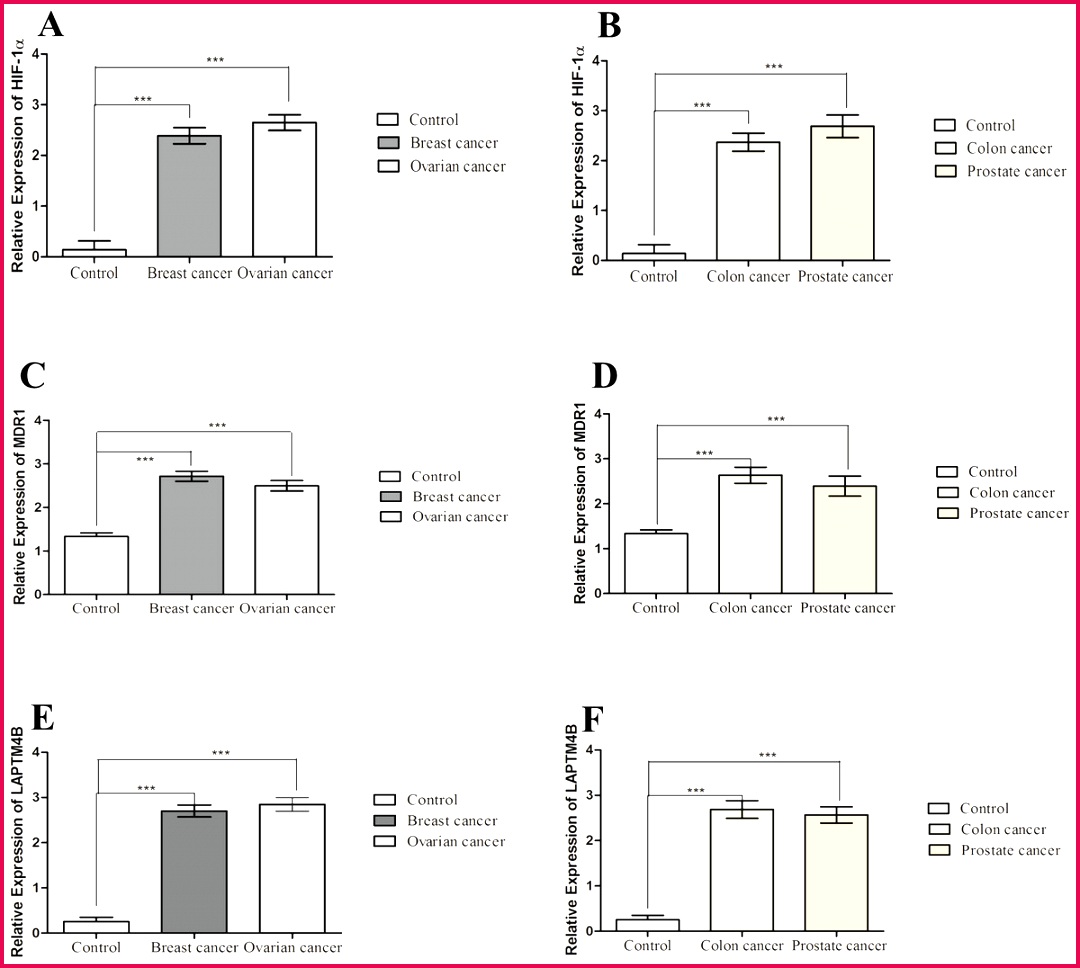 Co expression of HIF 1α MDR1 and LAPTM4B in peripheral blood of 1080968 Expression of HIF 1α MDR1 and LAPTM4B