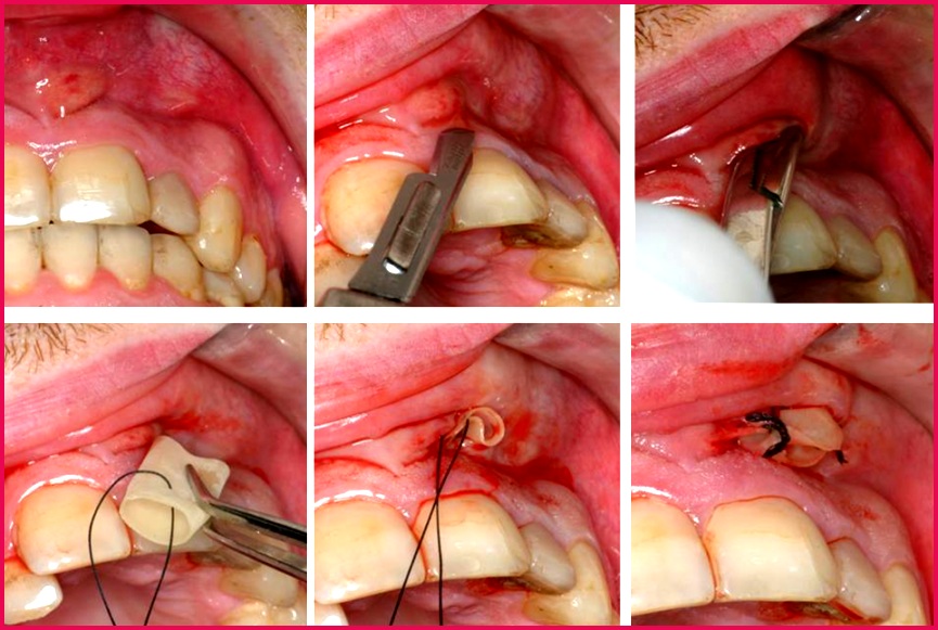 Incision of an abscess above a front tooth and insertion of a surgical drain