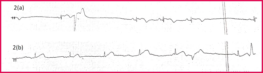 Figure 2 Telemetry rhythm strip revealing transient episodes of a sinus node dysfunction SND and b atrioventricular node AVN dissociation