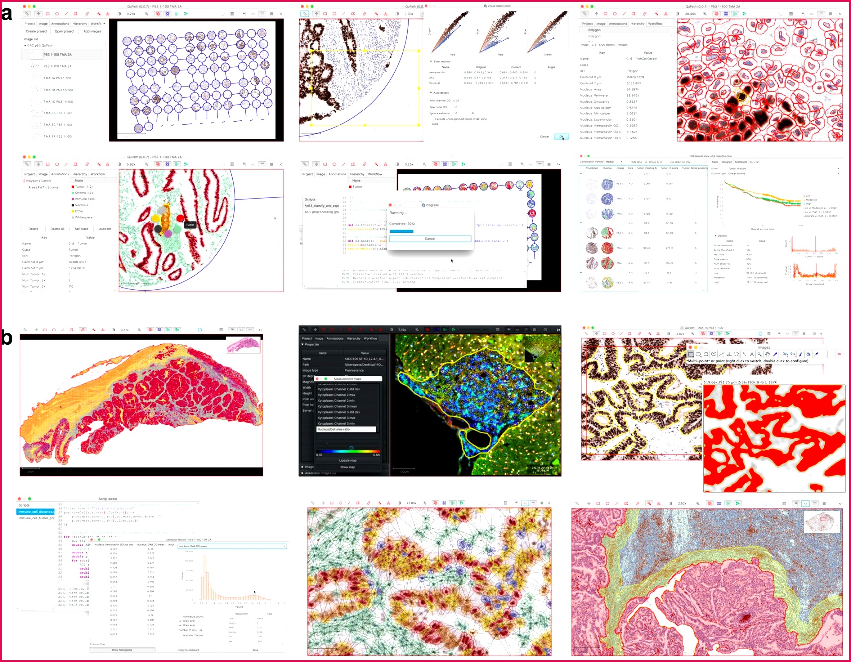 QuPath Open source software for digital pathology image analysis